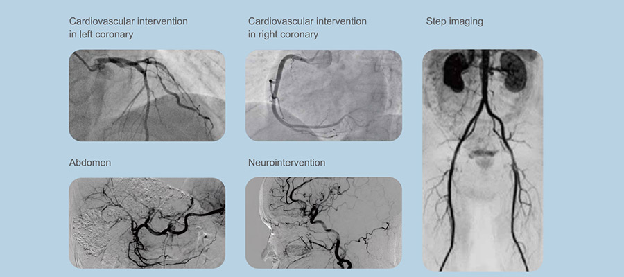 Vicor-CV Robin C/F Digital Subtraction Angiography System Vicor-CV Robin C/F Digital Subtraction Angiography System