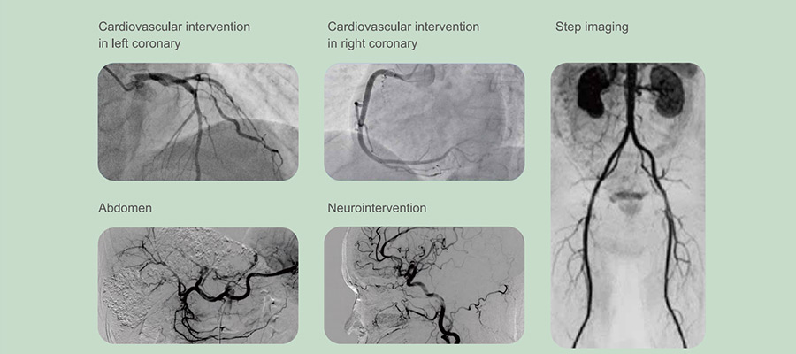 Vicor-CV SWIFT Digital Subtraction Angiography System Vicor-CV SWIFT Digital Subtraction Angiography System